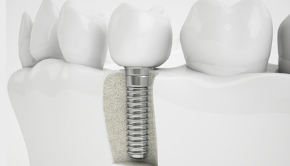 3D cross-section: an implant between two teeth in the jawbone