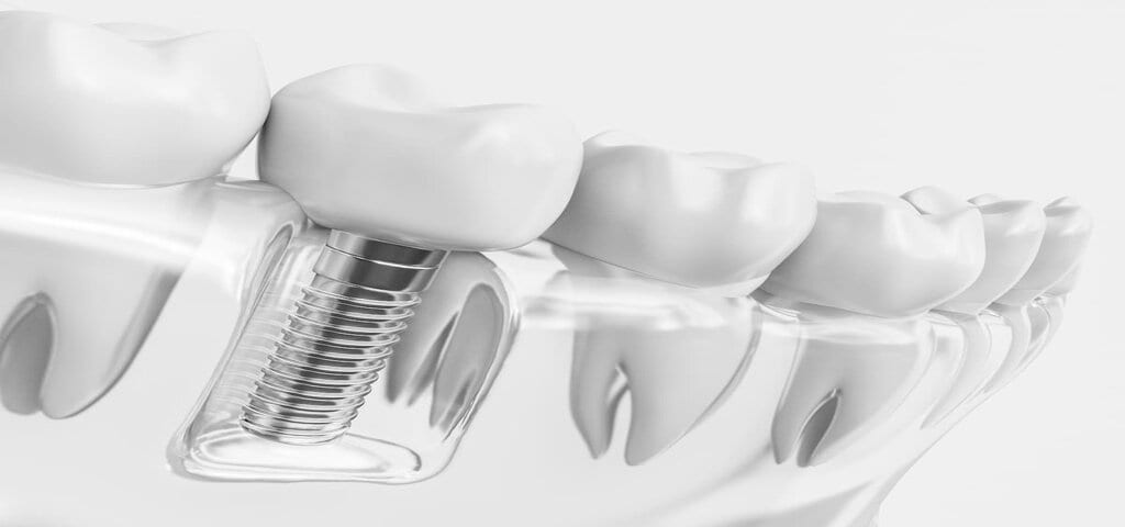 3D-Darstellung: Implantat mit Krone zwischen natürlichen Zähnen