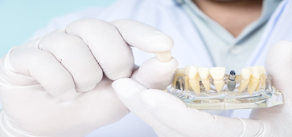 Behandschuhte Hand hält ein Kiefermodell mit Implantaten