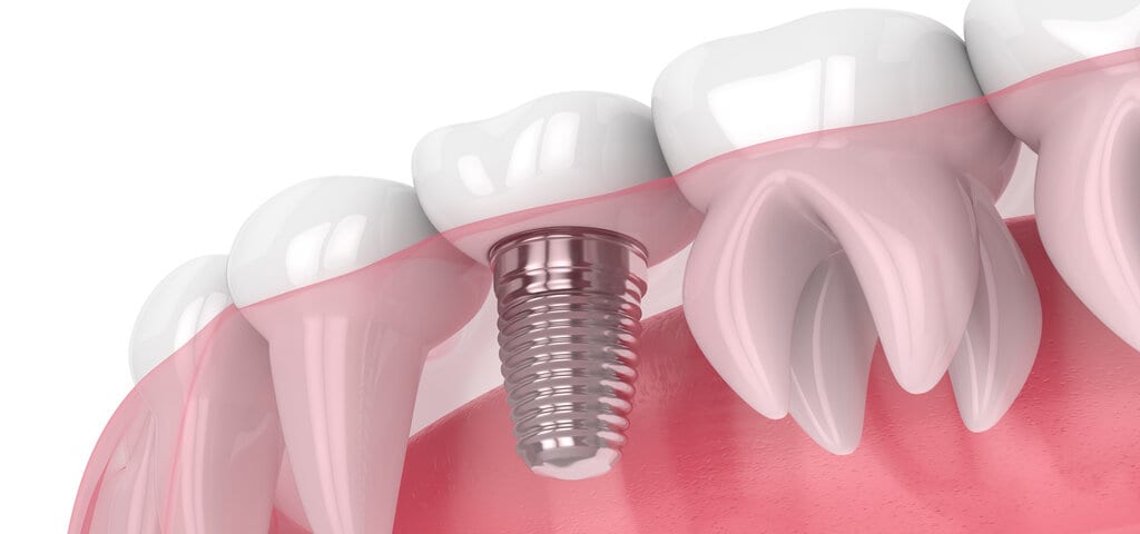 3D-Darstellung: Implantatschraube im Zahnfleisch zwischen zwei Zähnen