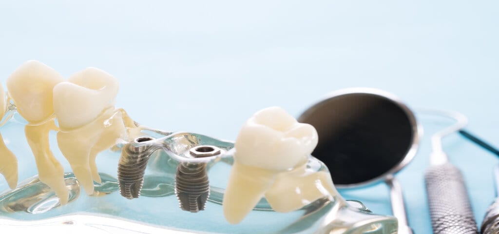 Zwei Implantate, ein Zahn und ein Mundspiegel auf einer Ablage